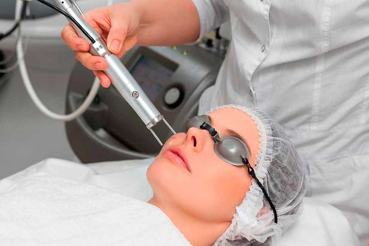 RF vs. Glass Tube: Demystifying CO2 Laser Sources